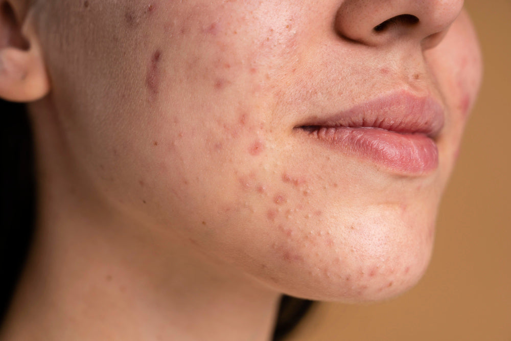 How to Reduce Skin Redness - Tips for Calming Irritated Skin!
