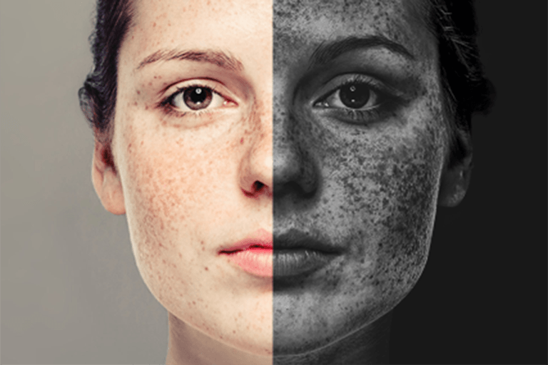 Understanding Hyperpigmentation: Causes and Treatment Options