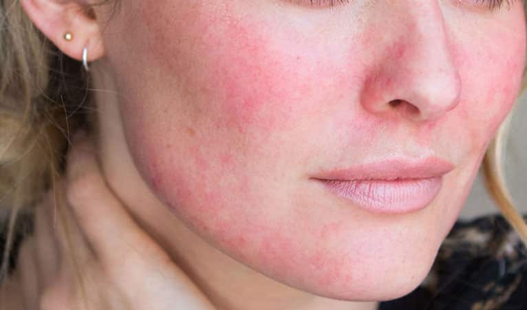 Redness/Rosacea/Sensitive Skins